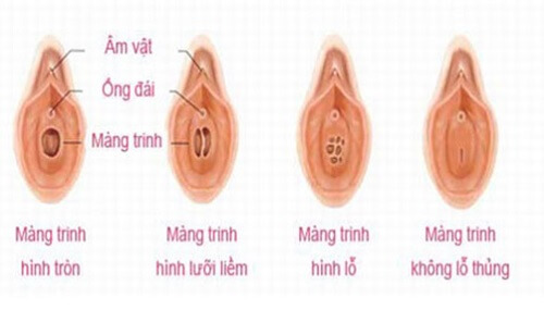 Hình ảnh màng trinh bình thường